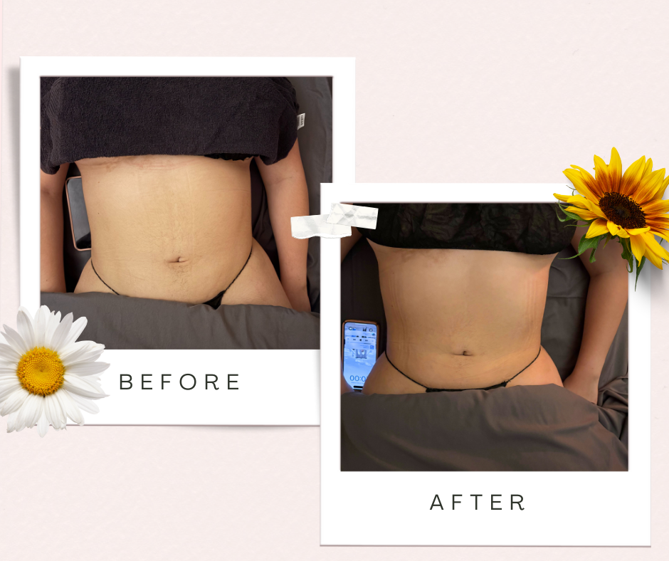 Ultrasonic Cavitation and Thermalift 2 sessions