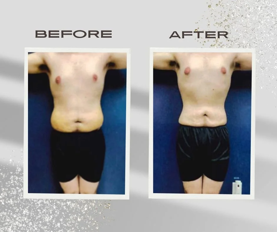 Post Surgical Lymphatic Drainage 2.5 Weeks