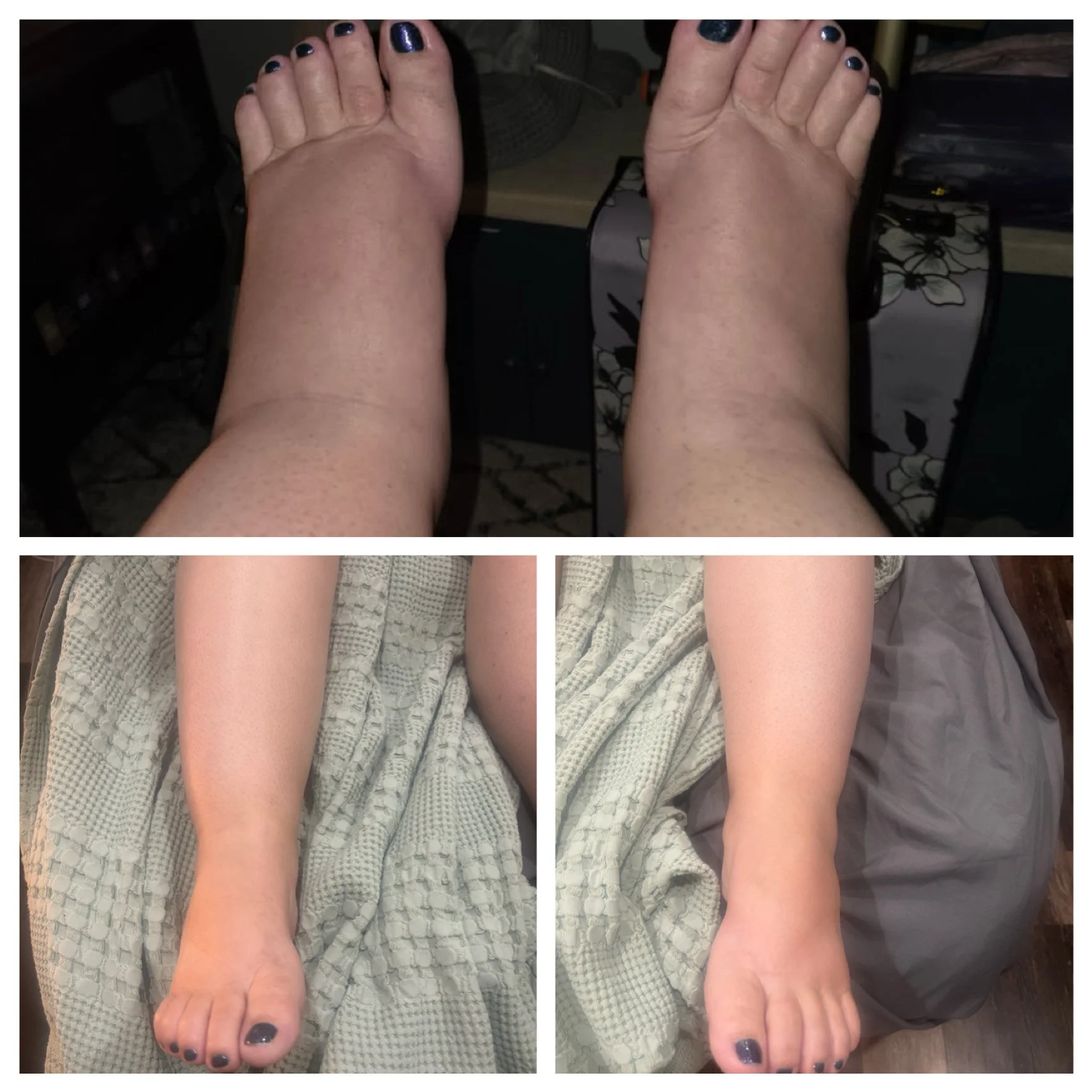 Lymphatic Drainage Therapy 