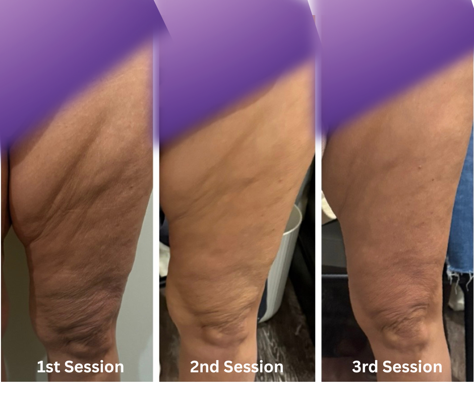 ThermaLift Radio Frequency Skin Tightening