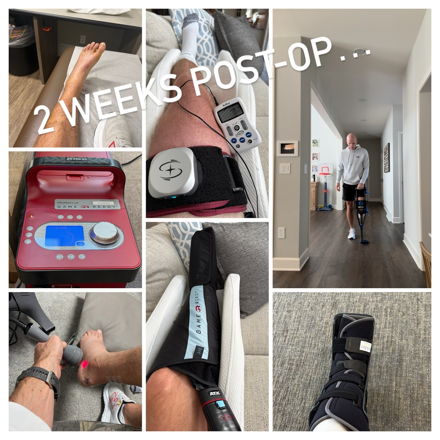 2 Weeks Post-Op Update 🦵⚡️

Two weeks down since surgery and progress is slowly starting to show.

➡️ I was in a soft cast for the first 2 weeks and completely non-weightbearing on my left leg. The iWalk crutch was a lifesaver &mdash; made stairs an
