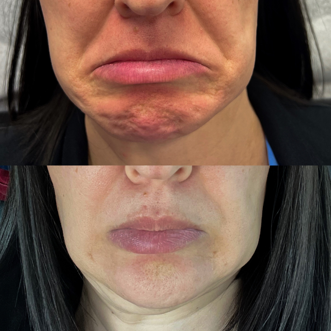 lower face and chin dysport results at forma health reno
