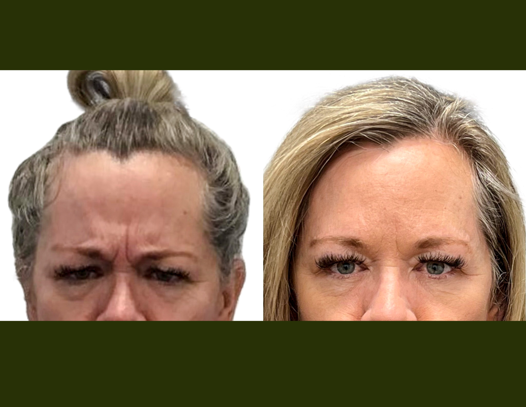 Glabella frown lines