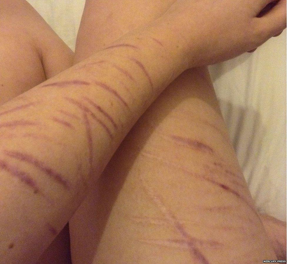 _88814885_mpm_girl_refused_alcohol_over_scars_06.jpg