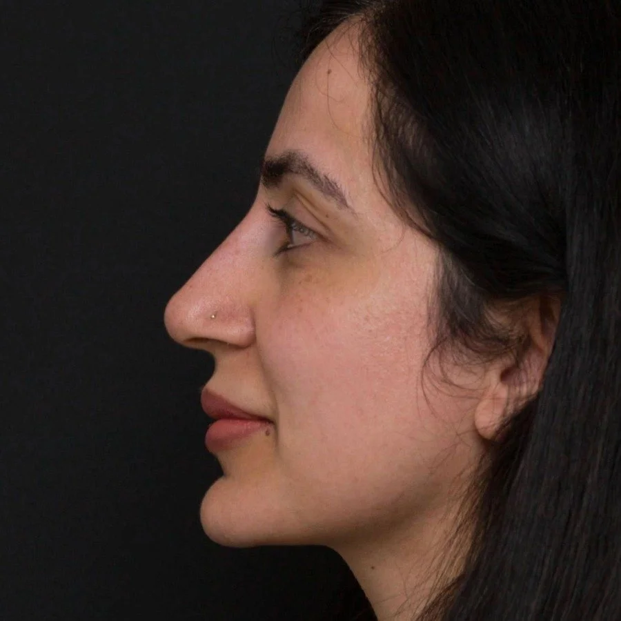 samia-after-right-v2.jpg