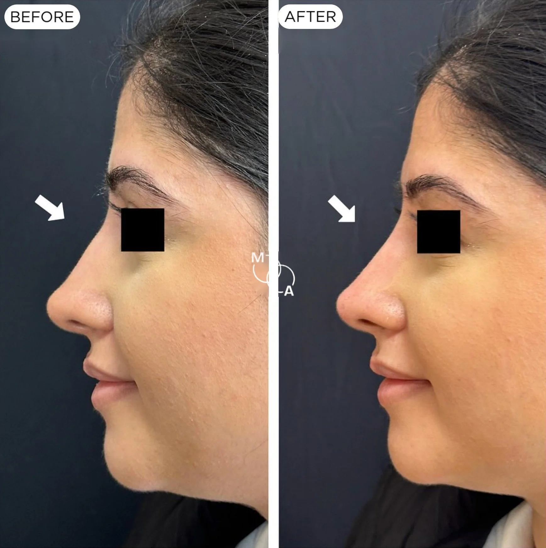 non-surgical-rhinoplasty-reigate-before-after-07.jpg