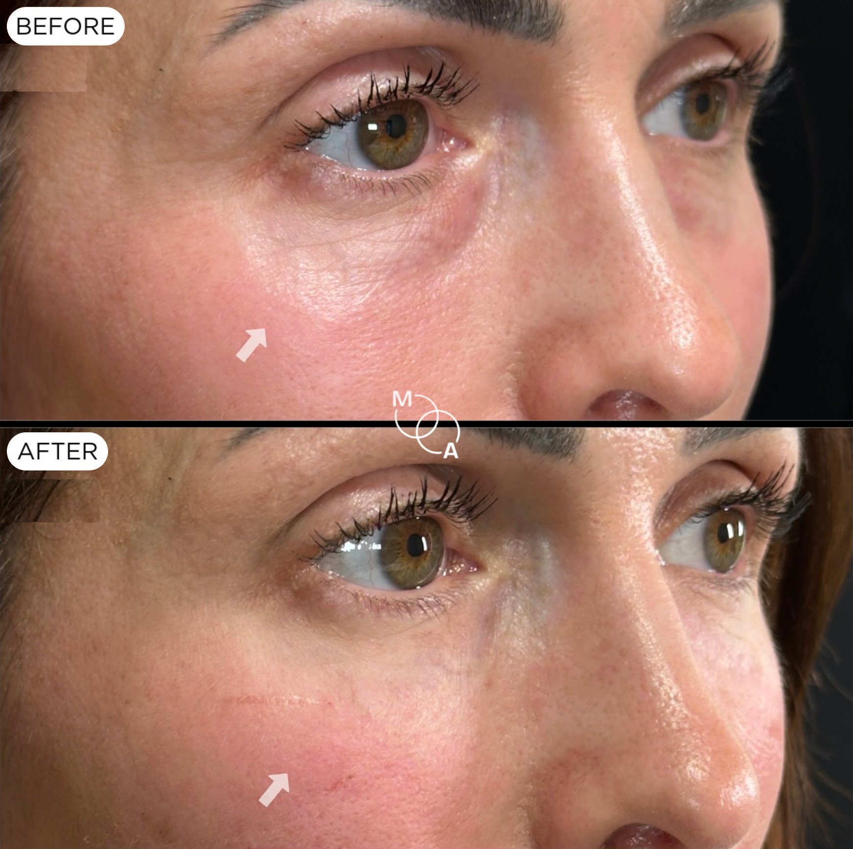 tear-trough-filler-reigate-before-after-06.jpg