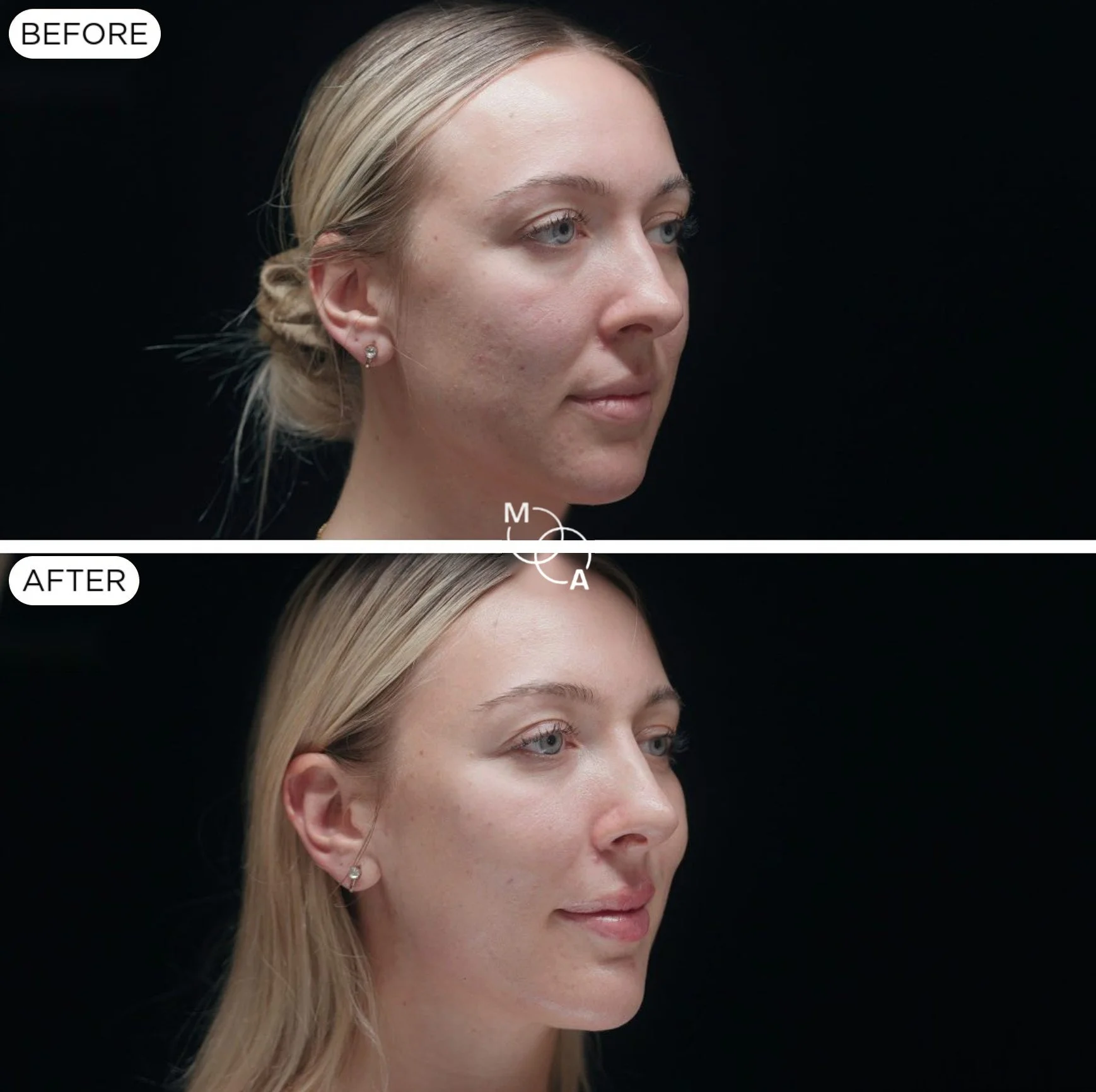 cheek-filler-reigate-before-after-08.jpg