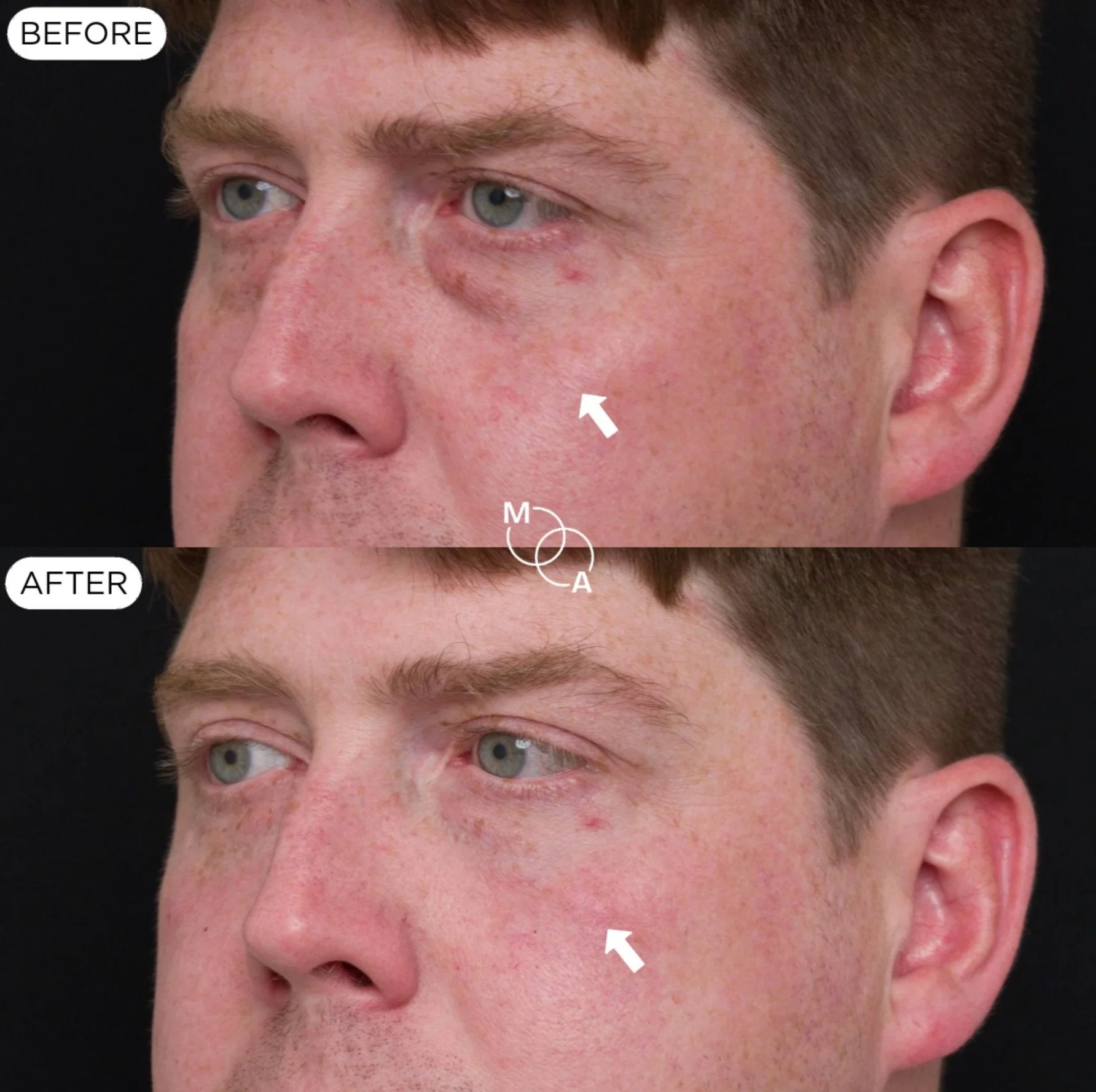 tear-trough-filler-reigate-before-after-05.jpg