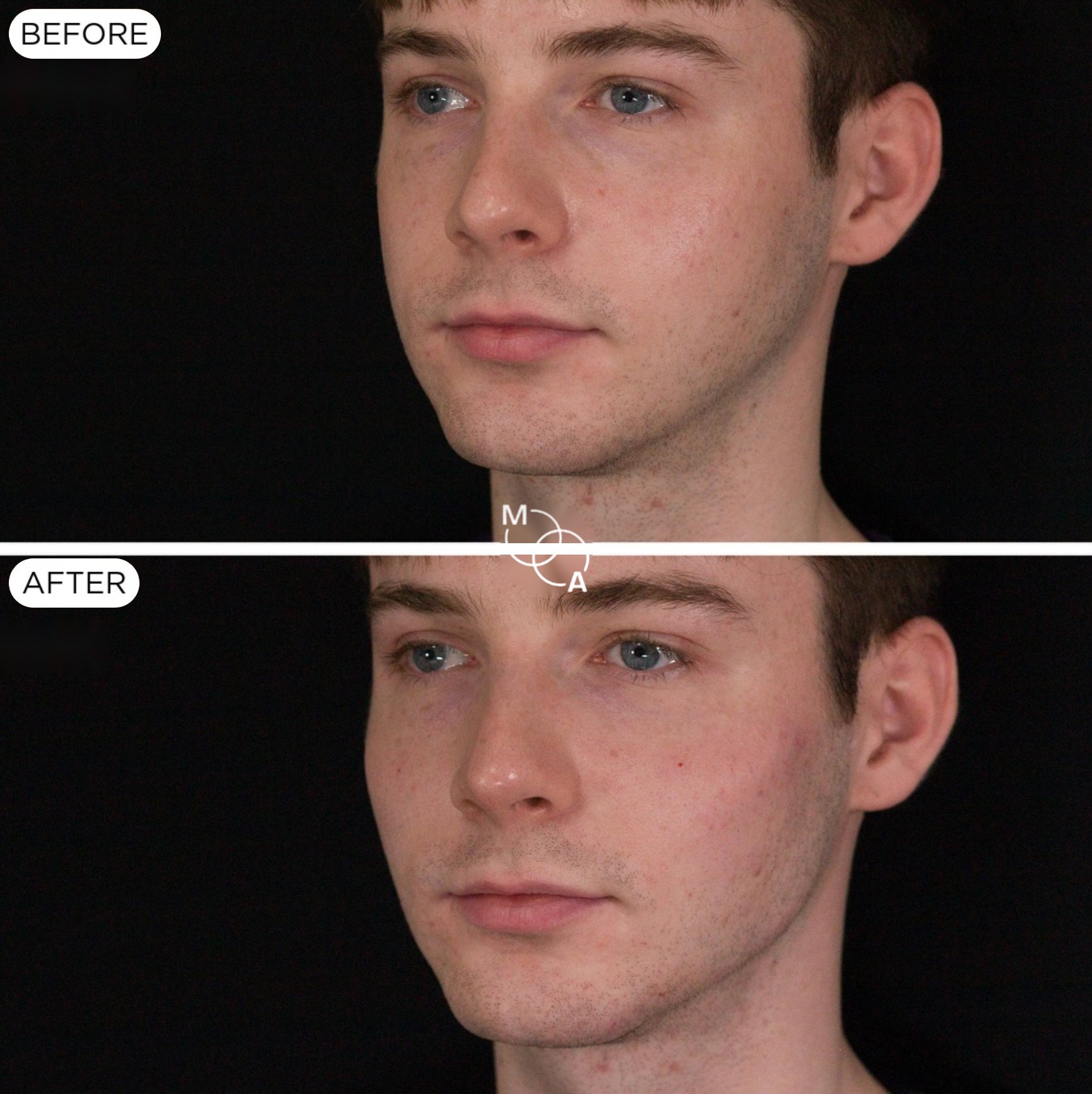 cheek-filler-reigate-before-after-07.jpg