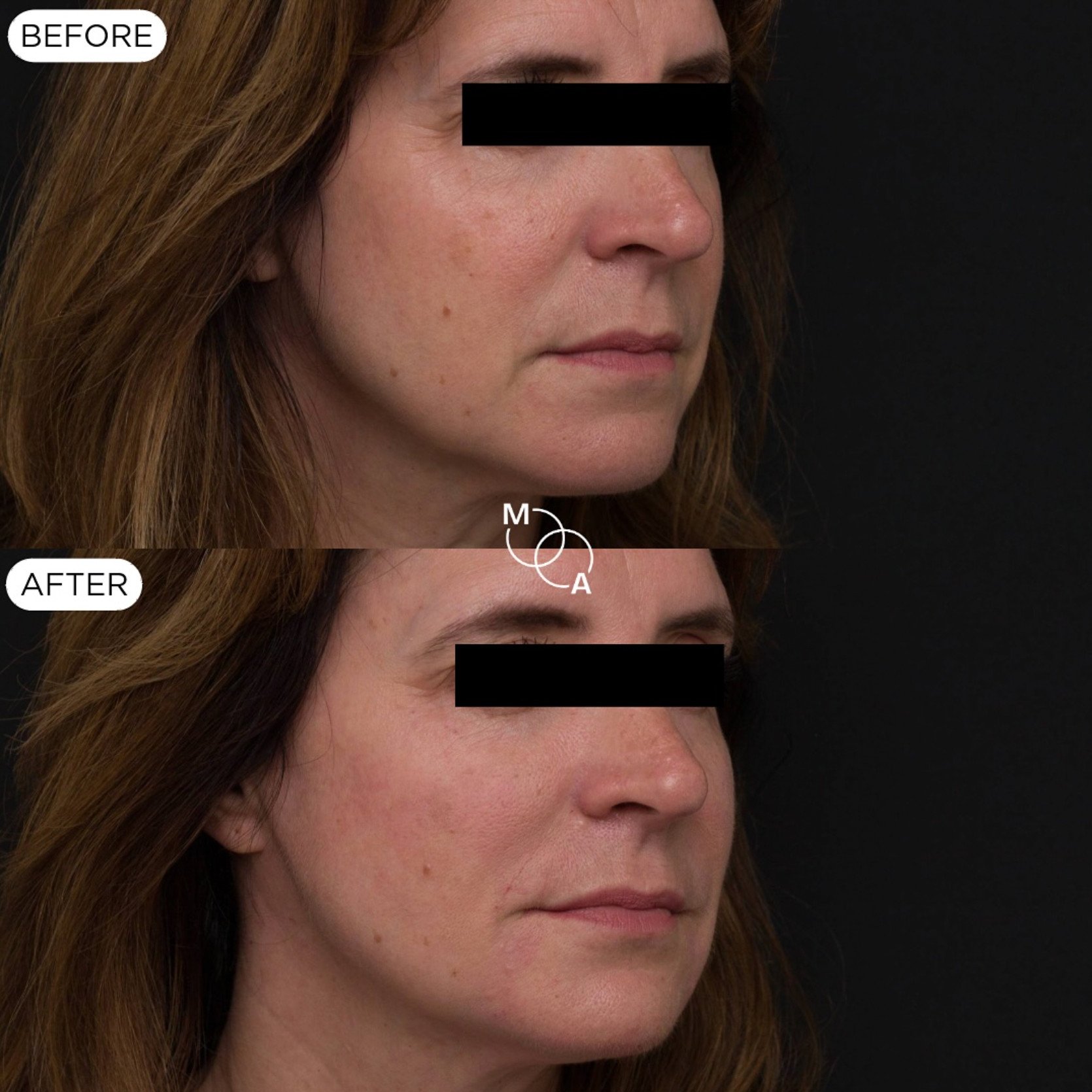 nasolabial-filler-reigate-before-after-04.jpg