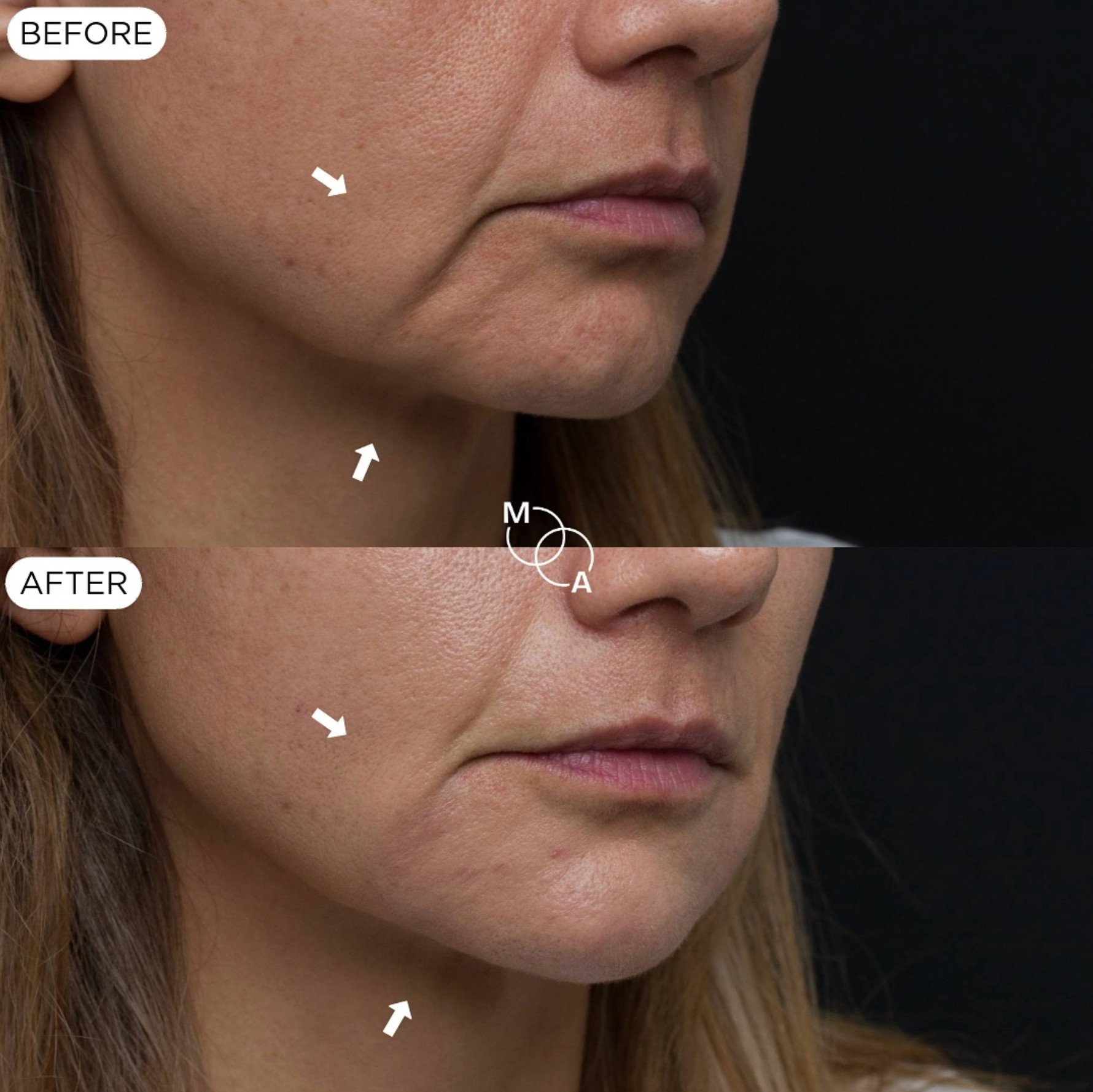 nasolabial-filler-reigate-before-after-03.jpg