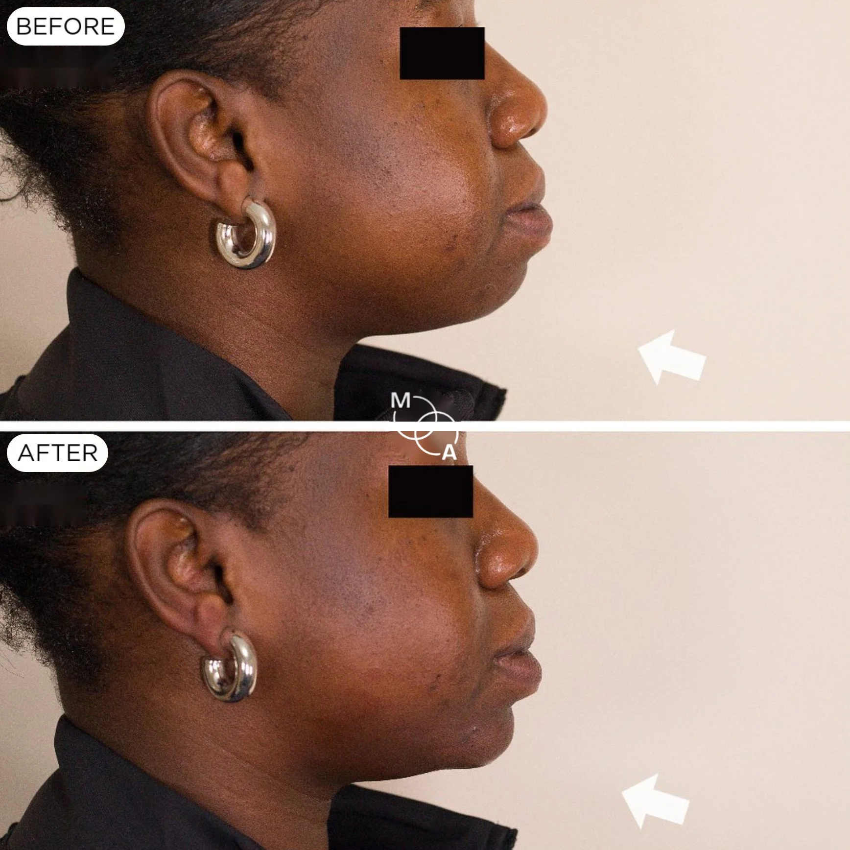 chin-filler-reigate-before-after-03.jpg