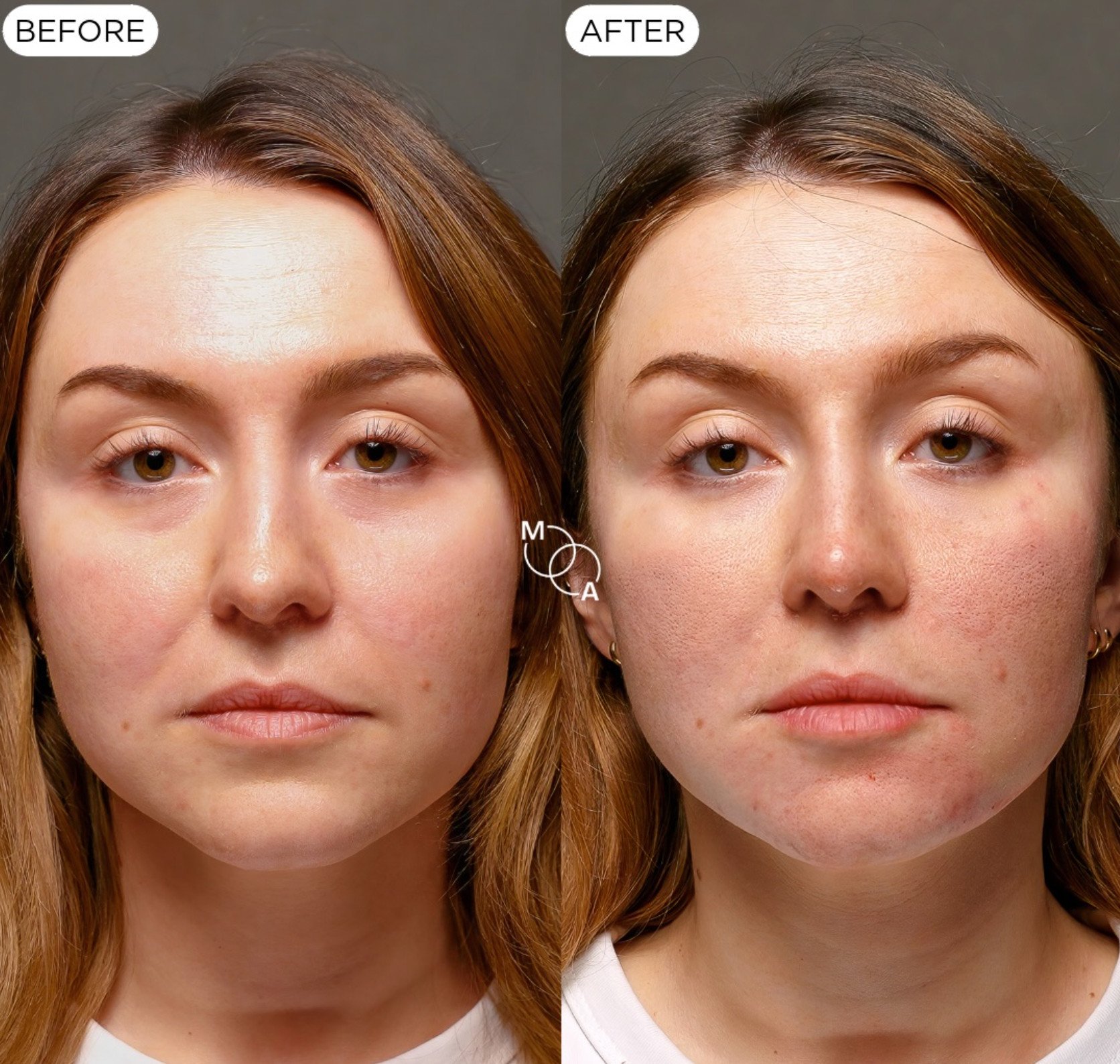 tear-trough-filler-reigate-before-after-03.jpg