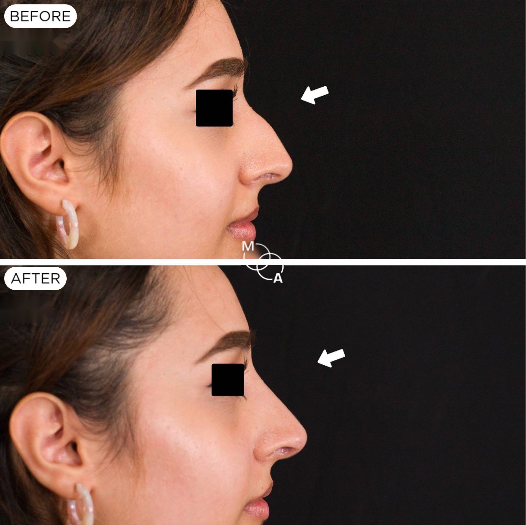 non-surgical-rhinoplasty-reigate-before-after-08.jpg