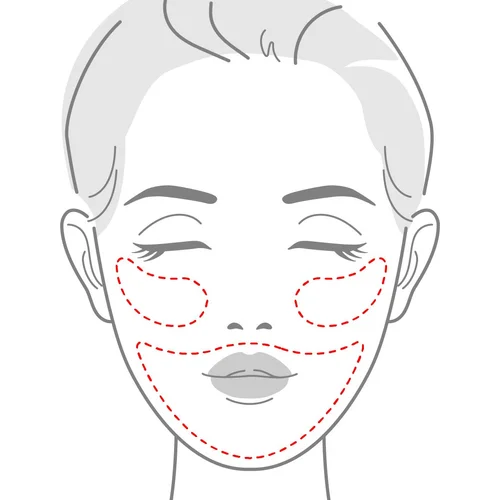 Illustration of the face with the areas treated with skin boosters marked, including under the eyes