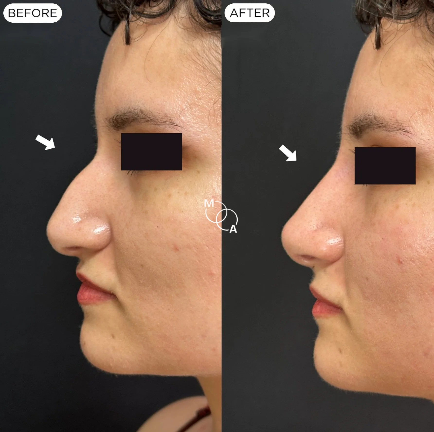 non-surgical-rhinoplasty-reigate-before-after-05.jpg