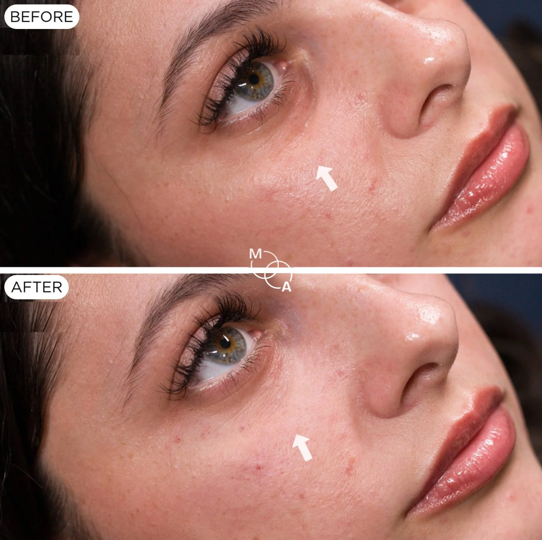 tear-trough-filler-reigate-before-after-08.jpg
