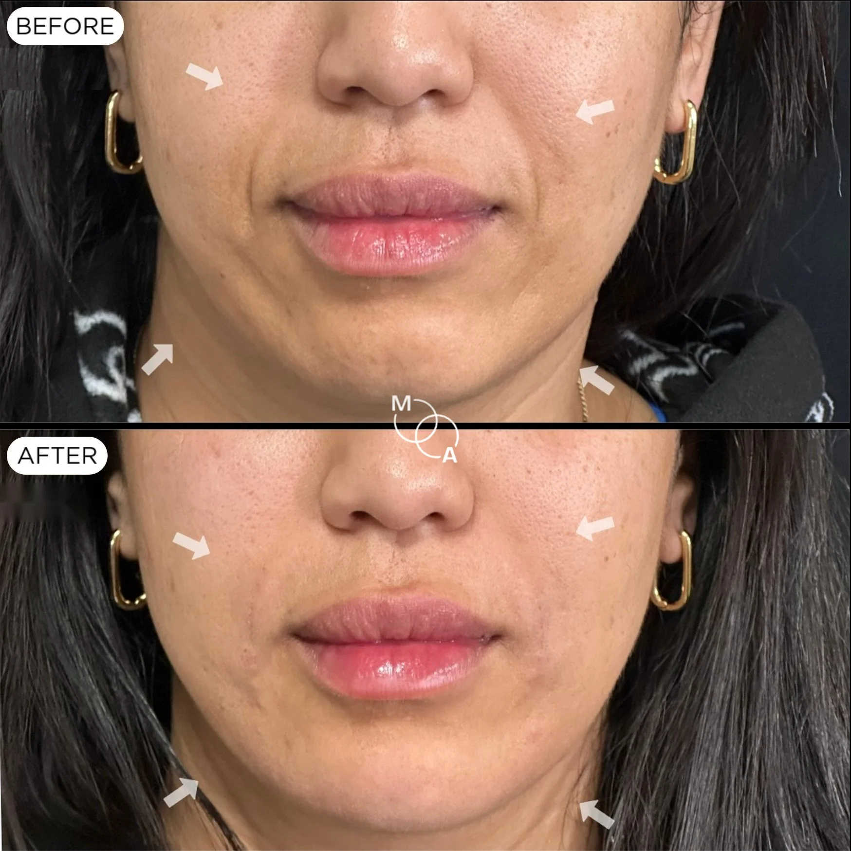 nasolabial-filler-reigate-before-after-08.jpg