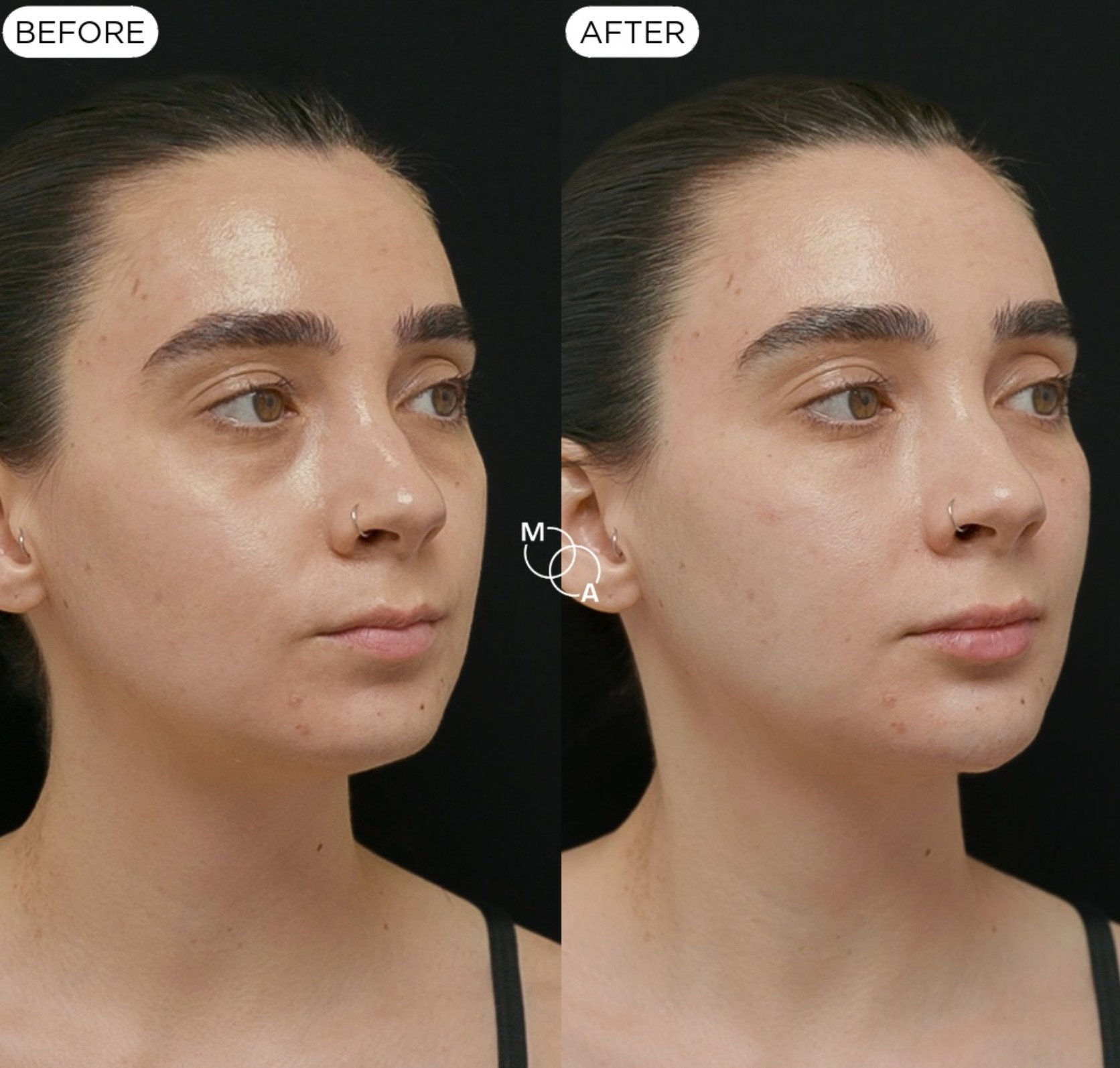 tear-trough-filler-reigate-before-after-04.jpg
