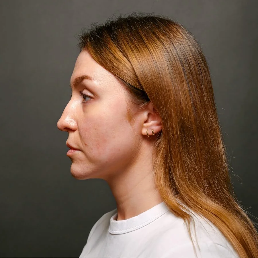 freixnet-before-side.jpg
