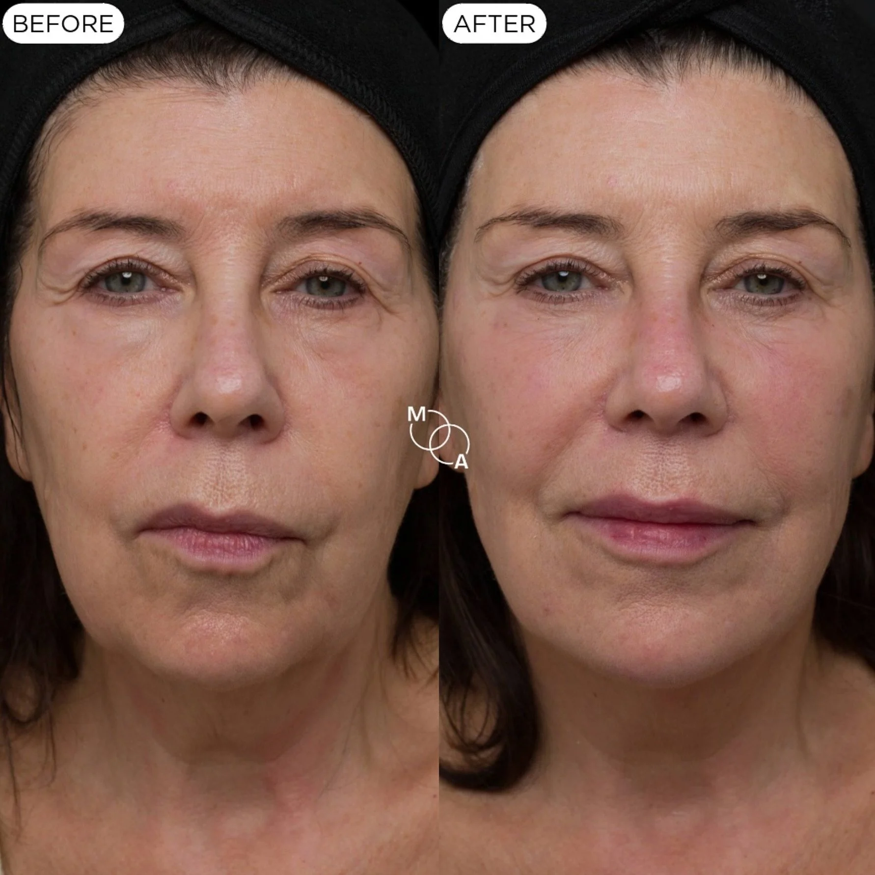 cheek-filler-reigate-before-after-04.jpg