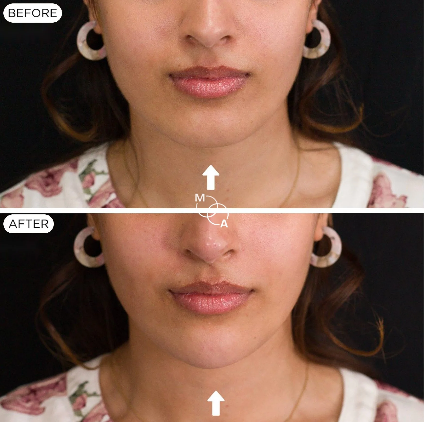 chin-filler-reigate-before-after-01.jpg