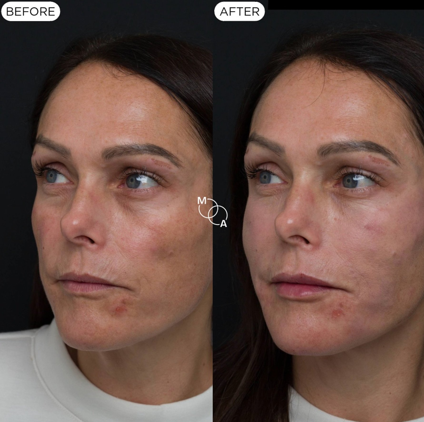 cheek-filler-reigate-before-after-03.jpg
