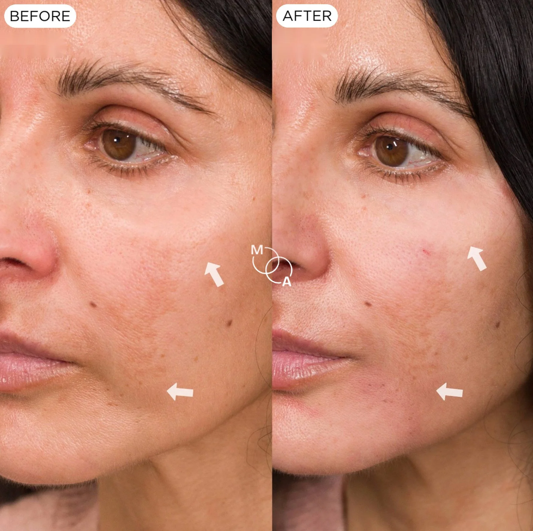 nasolabial-filler-reigate-before-after-07.jpg
