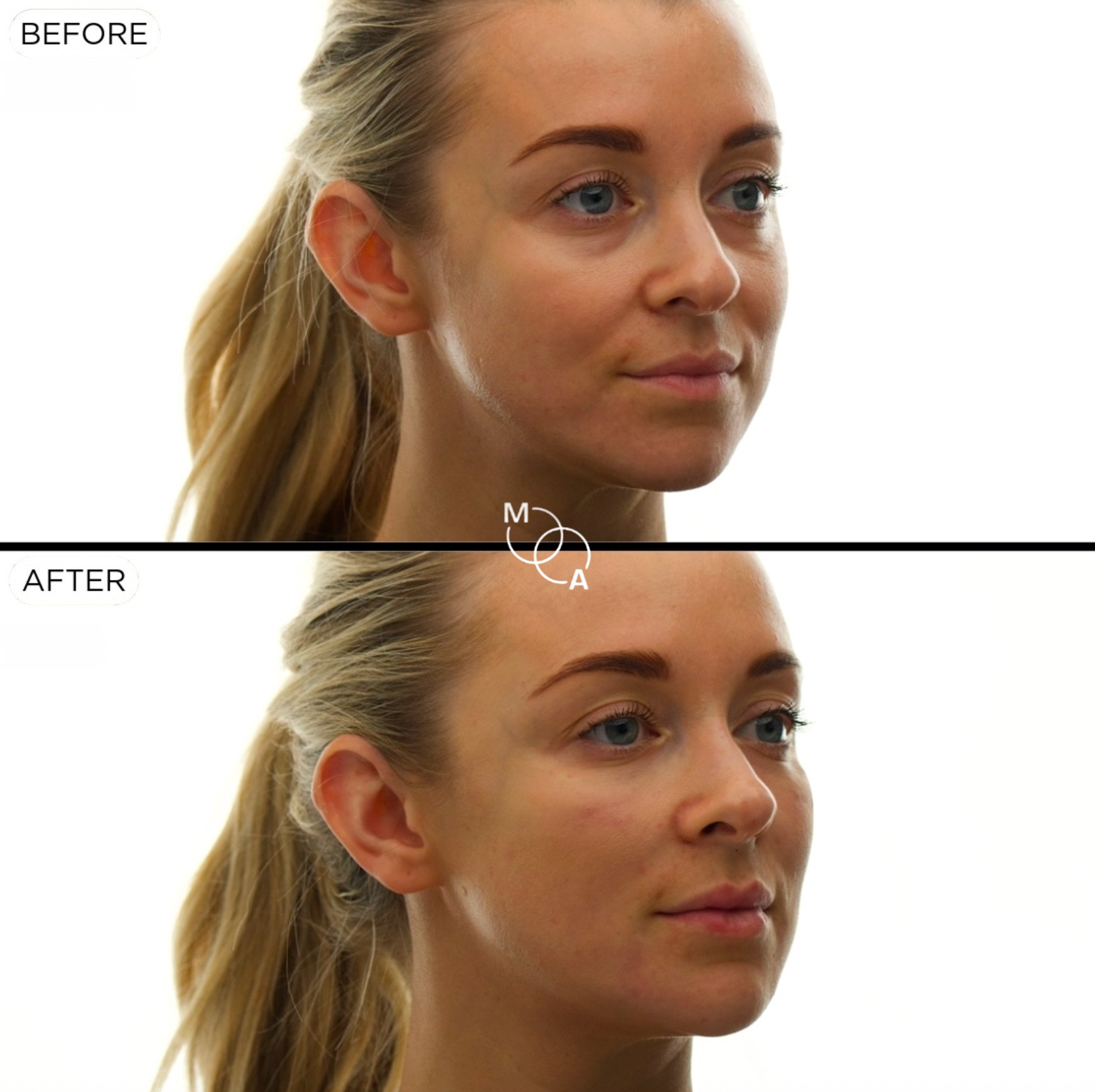 cheek-filler-reigate-before-after-06.jpg