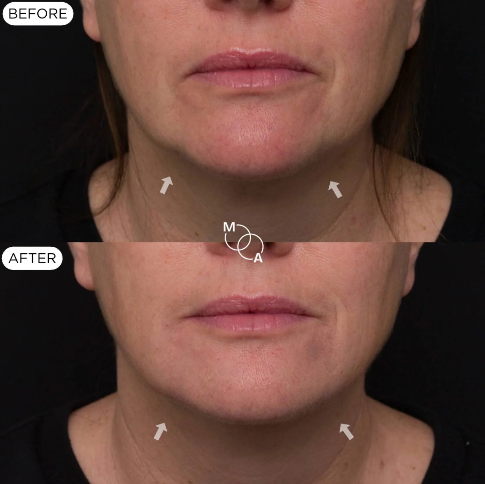 nasolabial-filler-reigate-before-after-02.jpg