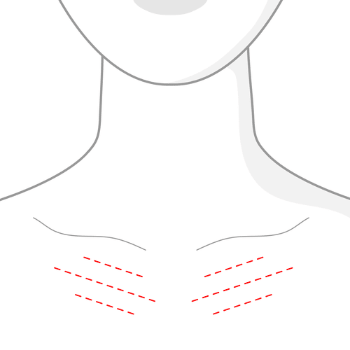 Illustration of the chest and neckline, marking the d&eacute;colletage area treated with skin boosters