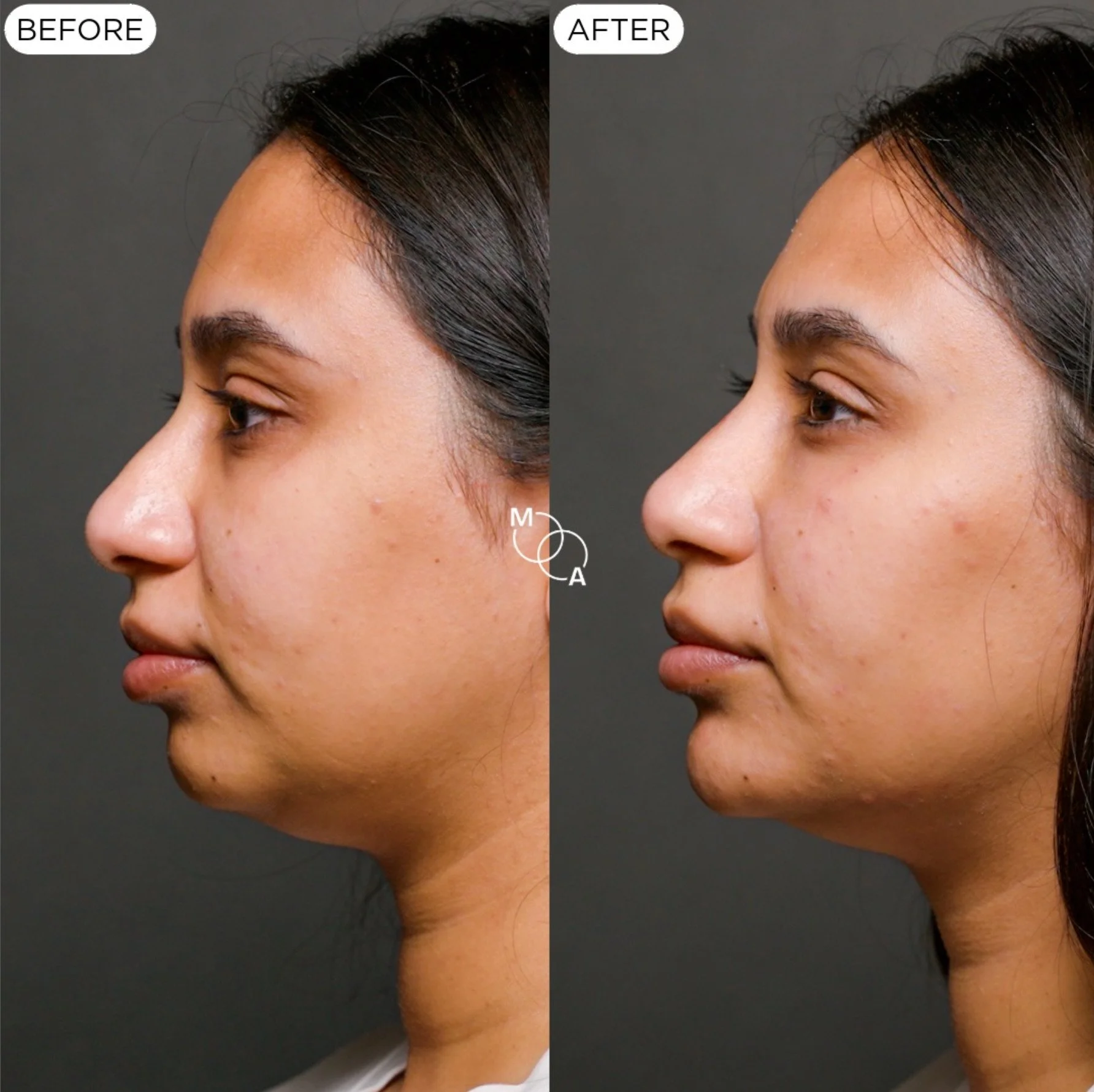 chin-filler-reigate-before-after-04.jpg