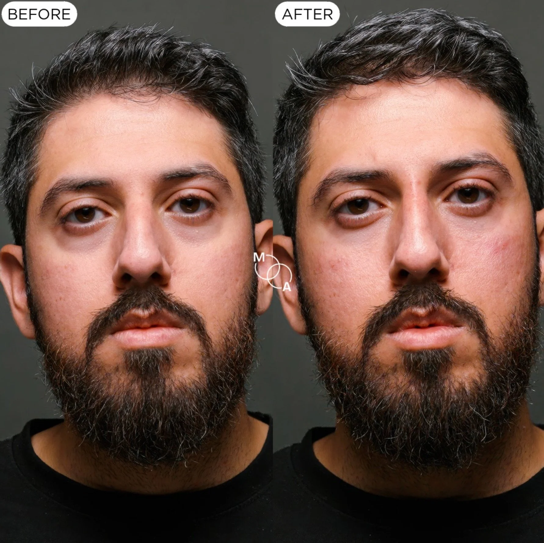 tear-trough-filler-reigate-before-after-01.jpg