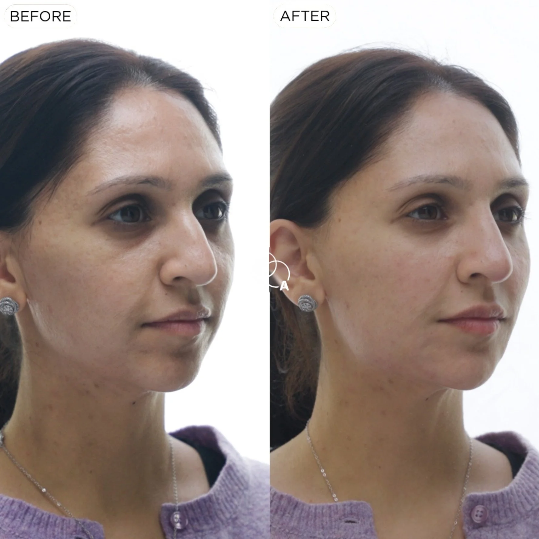 cheek-filler-reigate-before-after-02.jpg