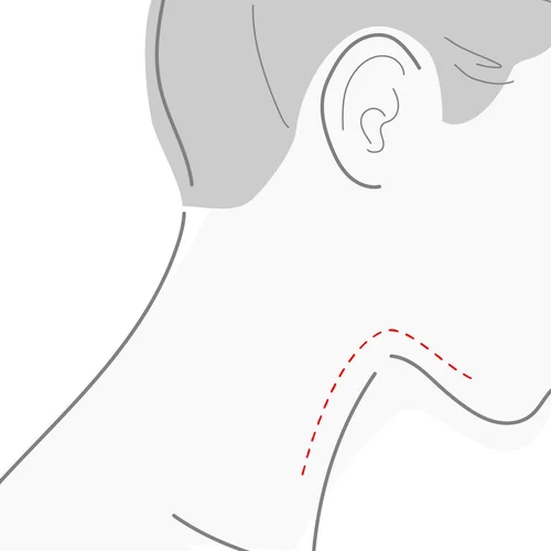 Illustration of the neck in profile, marking the area treated with skin boosters