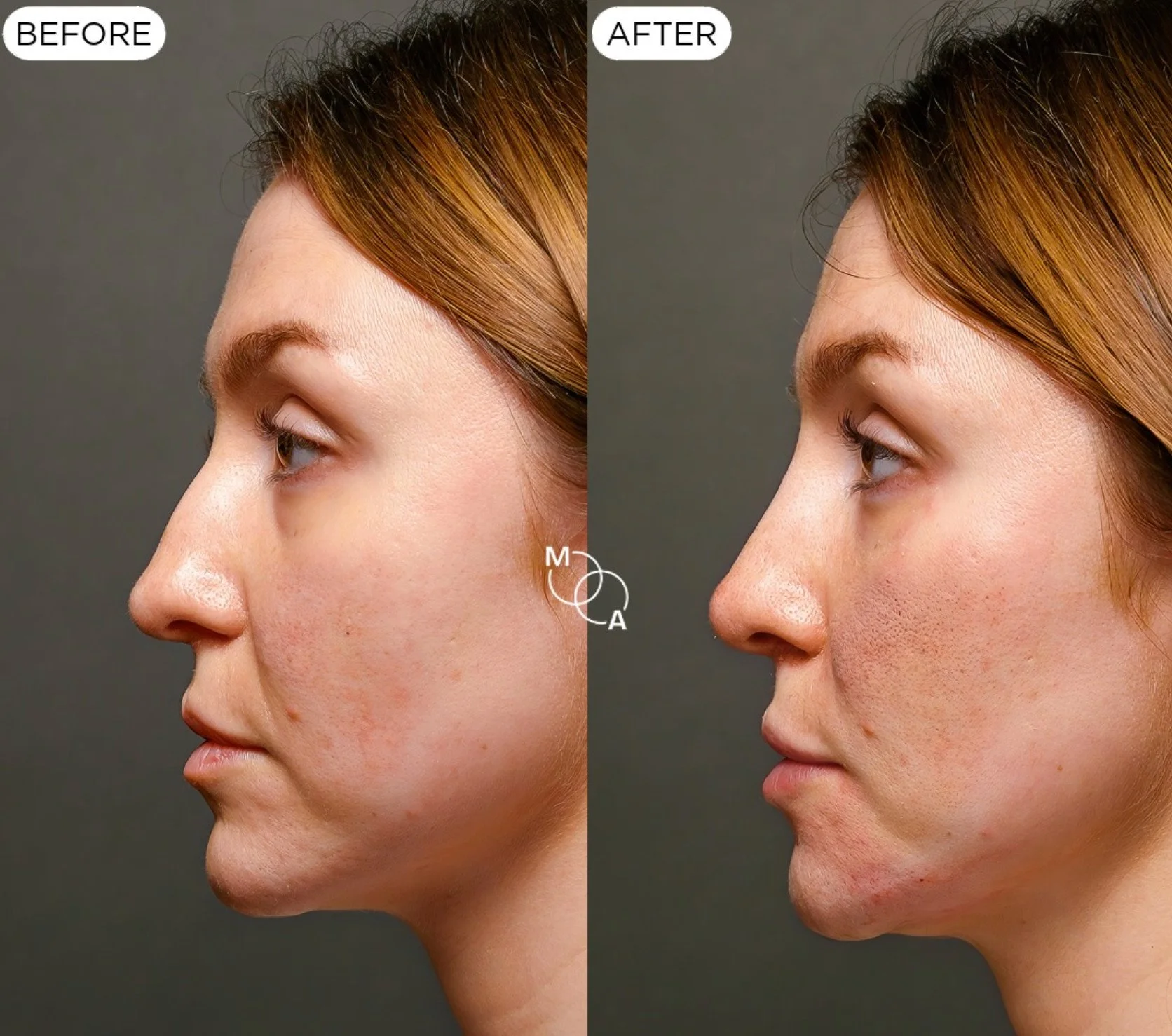 non-surgical-rhinoplasty-reigate-before-after-01.jpg