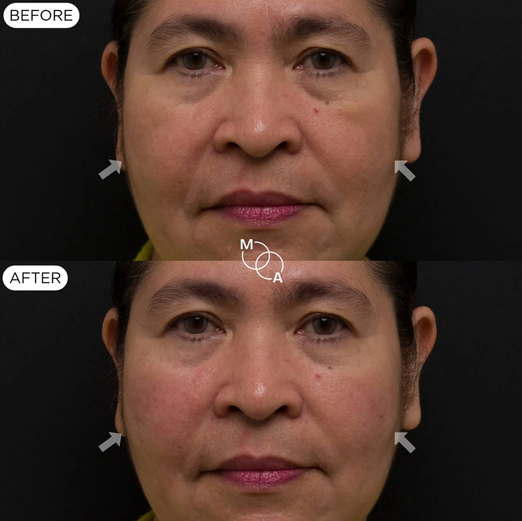 cheek-filler-reigate-before-after-05.jpg