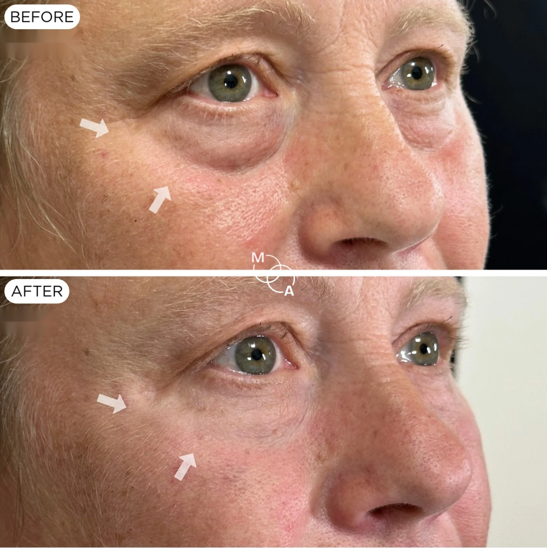 tear-trough-filler-reigate-before-after-07.jpg