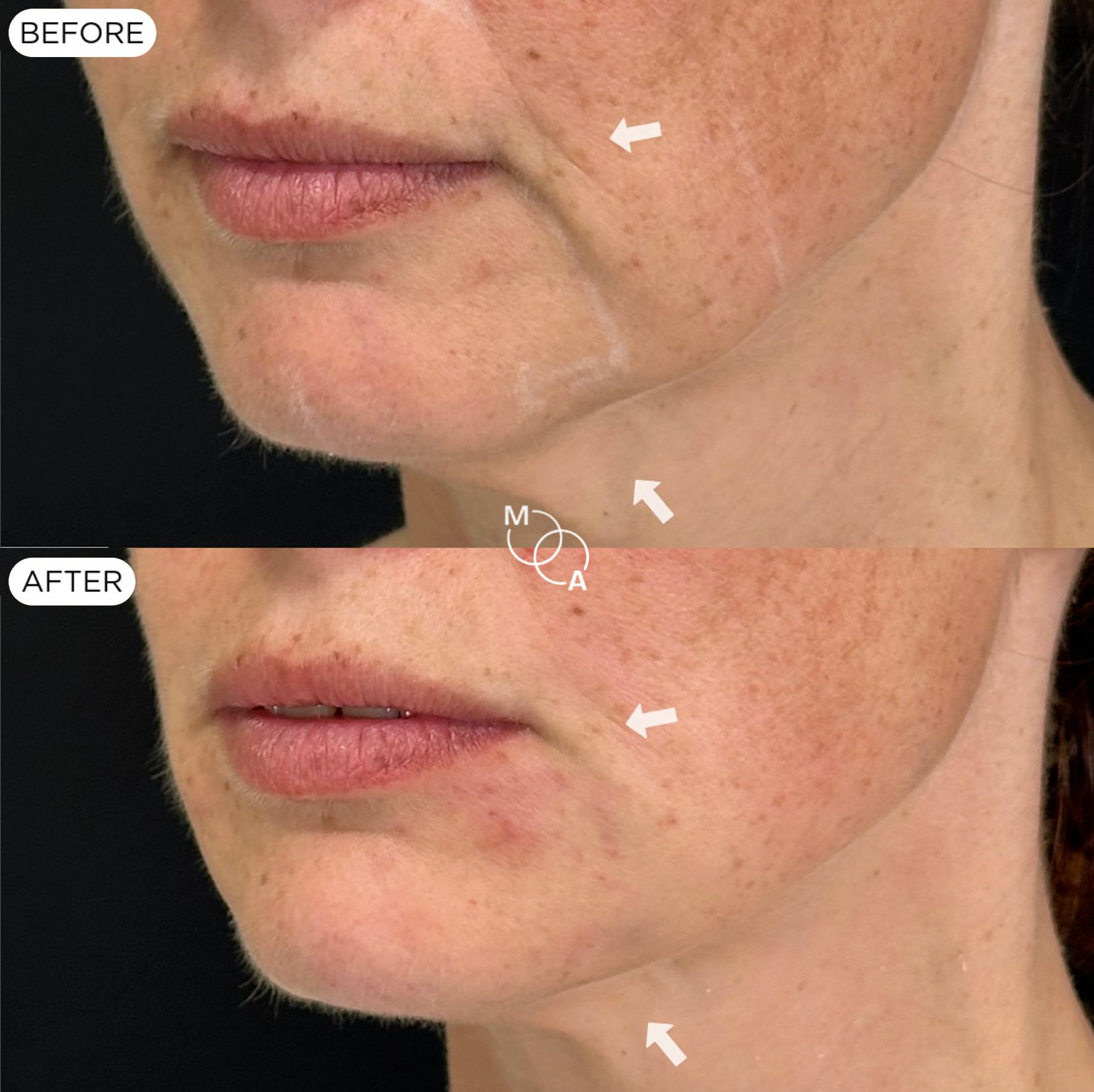 nasolabial-filler-reigate-before-after-06.jpg
