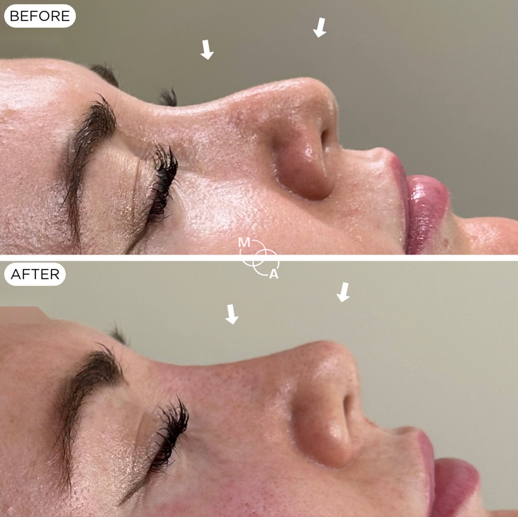 non-surgical-rhinoplasty-reigate-before-after-06.jpg