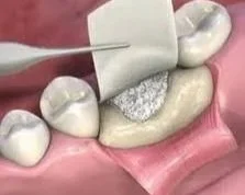 A dental procedure with a dental dam, a needle, and a tooth being prepared for a filling or restoration.