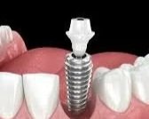 Close-up of a dental implant replacing a missing tooth, with surrounding natural teeth and gums.