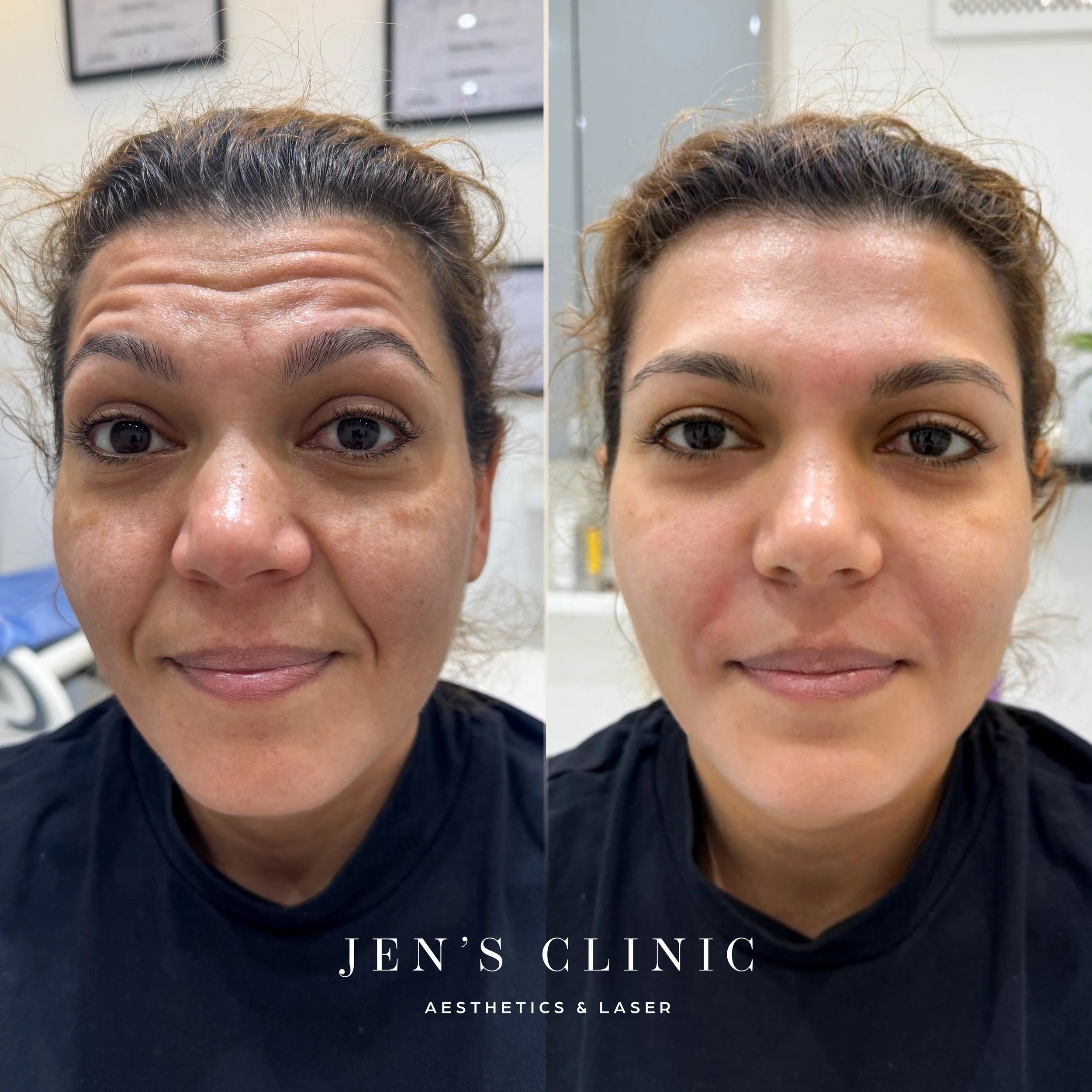 Client Romanian_Botox_Insta.jpg