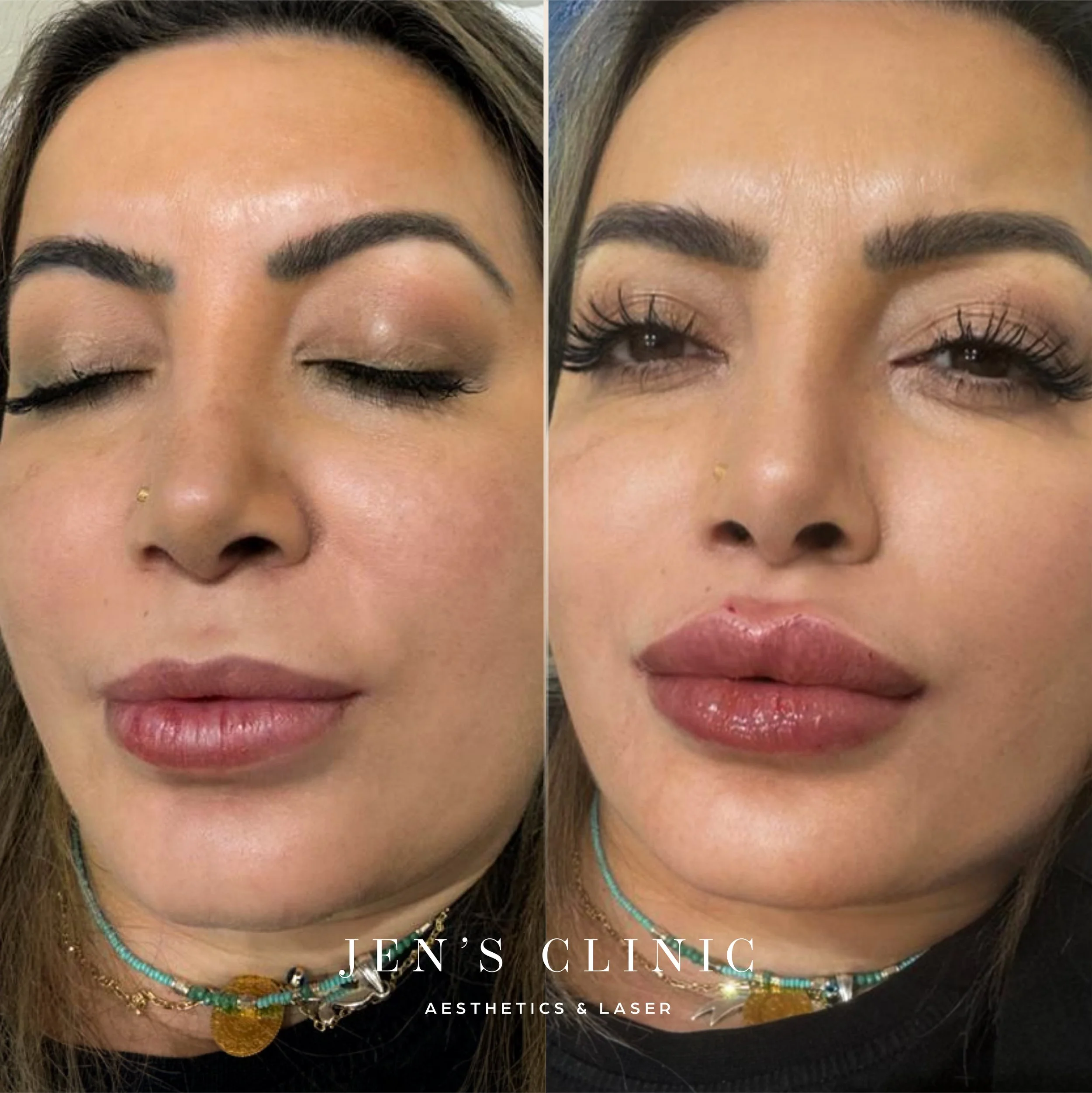 Client Ayse_Lip filler_Insta.jpg