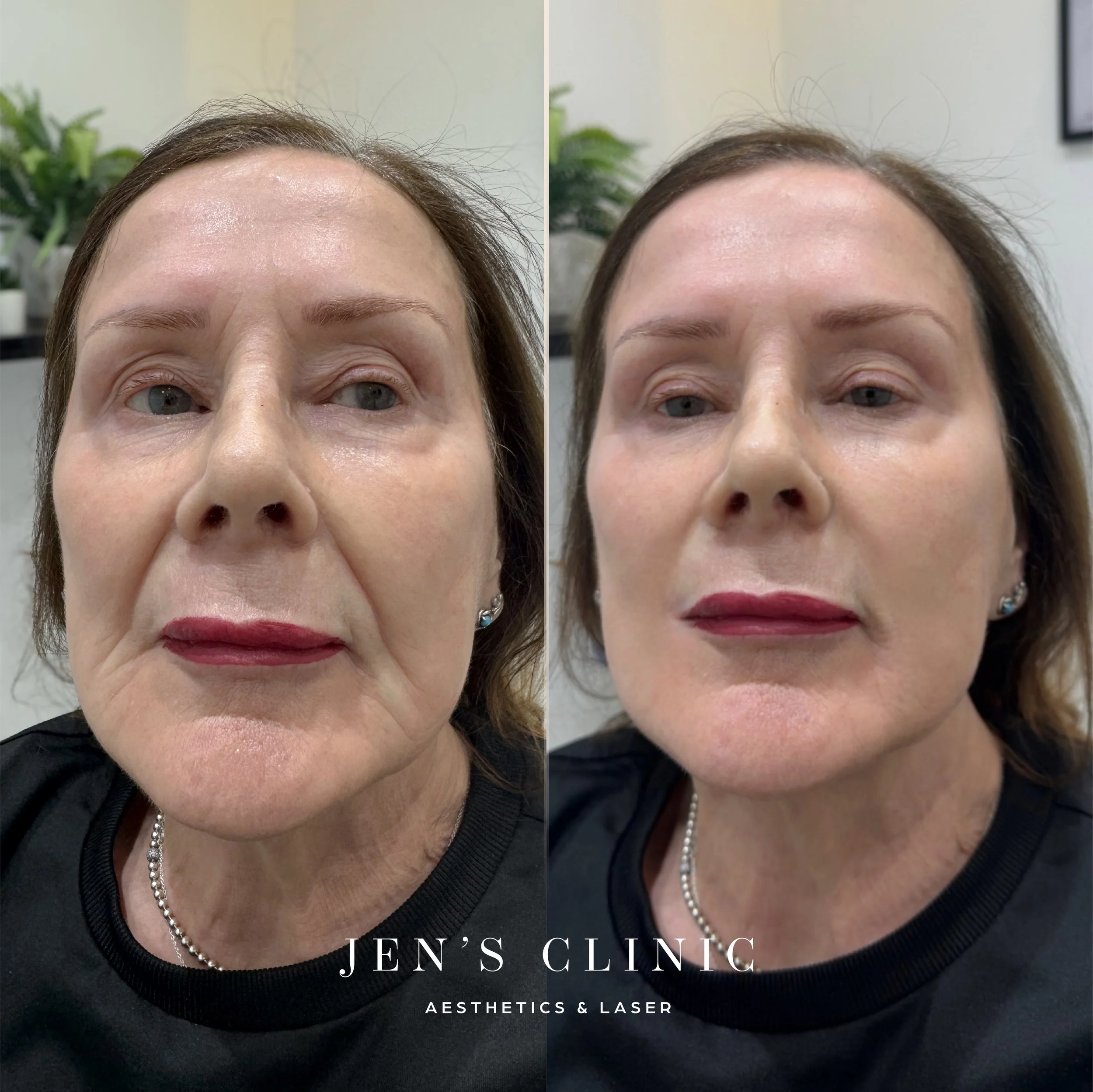 Client 2_Nasalabial filler_Insta.jpg