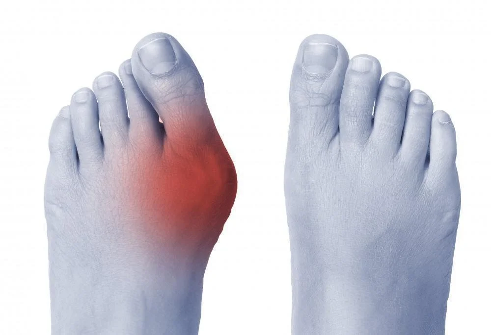 Bunions in KL: How They Sneak into Your Daily Life