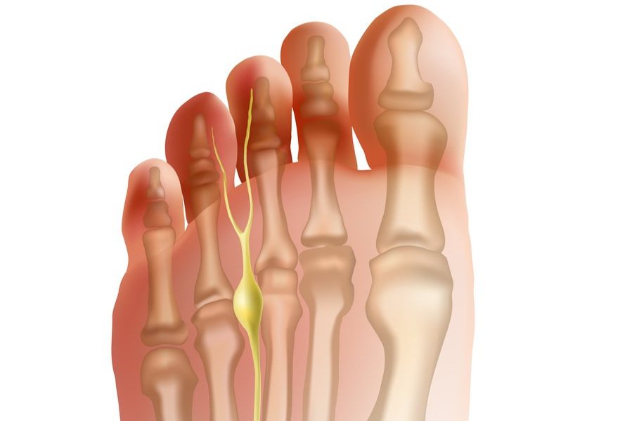 Morton’s neuroma is nerve pain between the toes often triggered by tight shoes, treated with pressure relief and custom care at KL Foot Specialist Podiatry.