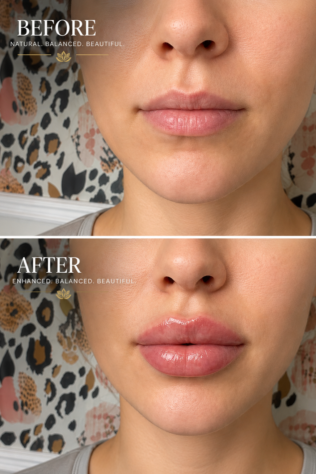 1 Syringe of Evolysse Smooth Lip Filler