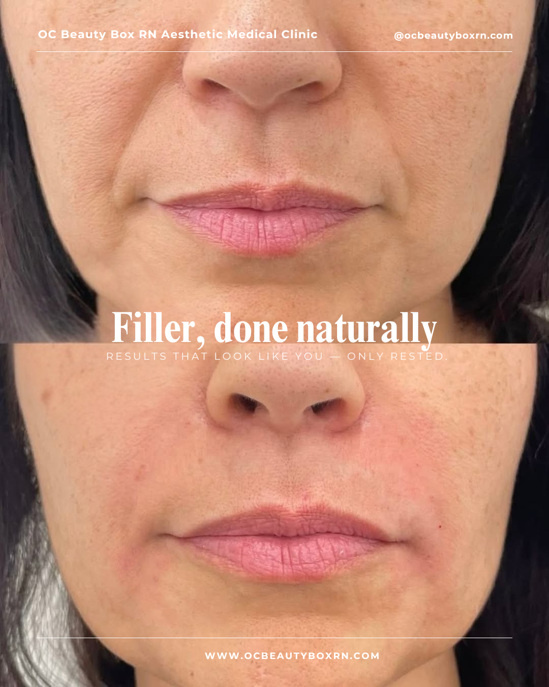 1 Syringe Nasal Labial Fold Crease Filler 1/2 Bilateral